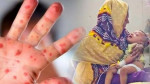 একদিনে নতুন হামরোগী ১১৪২, একজনের মৃত্যু