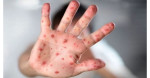 হামের উপসর্গে আরও ৭ শিশুর মৃত্যু